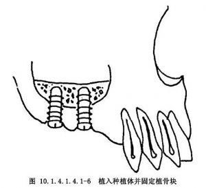 手指切口设计